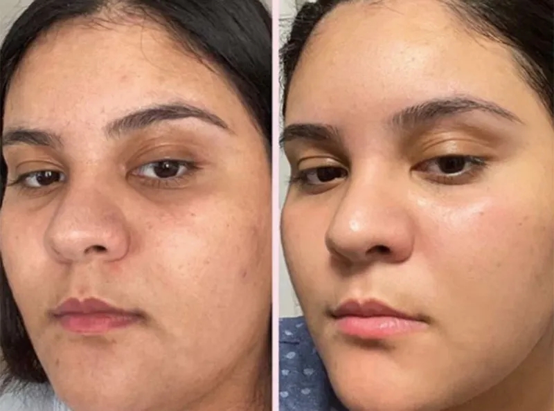 Comparaison avant et après soin visage anti-âge